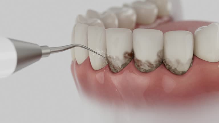 Trusted Wisdom Tooth Removal service in Fredericksburg, IA - Dentist Open Now